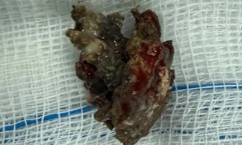 Hy hữu người đàn ông 58 tuổi mắc dị vật trong mũi nửa thế kỷ