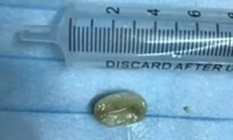 Ho kéo dài tưởng viêm phế quản, hóa ra do hạt lạc ‘đi lạc’ vào phổi