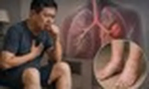 Bác sĩ cảnh báo, 4 BẤT THƯỜNG cảnh báo ung thư phổi: Nhiều người dễ bỏ qua vì tưởng chỉ là bệnh vặt