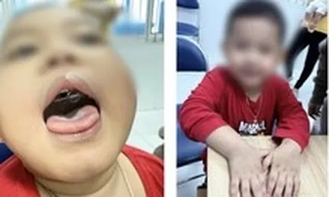 Ngưng thở khi ngủ kéo dài, bé trai tím tái cả khi thức suốt 2 năm