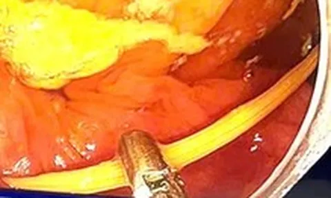 Đau bụng kéo dài, đi khám thì phát hiện que tăm 6,5cm gây thủng ruột non