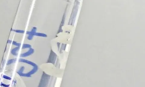 Bác sĩ kéo "thứ lạ" dài 7cm trong đùi người đàn ông Hà Nội: Nghi do một lần đi tắm cùng bạn bè