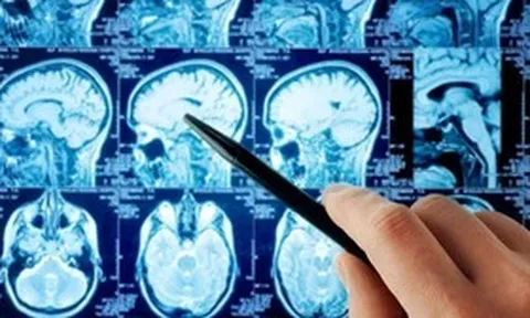 Từ ca đột quỵ ở tuổi 33: Vì sao người trẻ ngày càng đối mặt với “cơn ác mộng” này?