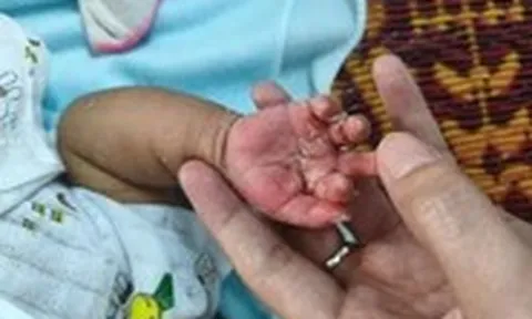 Trẻ 2 tháng tuổi mắc giang mai bẩm sinh, dễ nhầm bệnh ngoài da