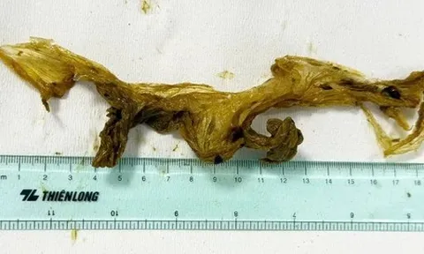 Hy hữu: Đau bụng, nội soi phát hiện trong ruột non có túi ni lông dài 20cm