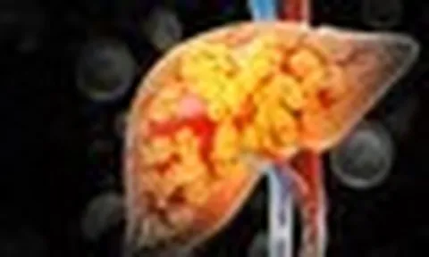 Không chỉ dầu mỡ, 1 loại gia vị nếu lạm dụng có thể khiến gan ‘ngập’ trong mỡ: Nhà ai cũng dùng mỗi ngày