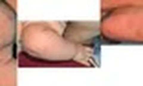 Nhiều trẻ mắc giang mai bẩm sinh vì mẹ bỏ lỡ xét nghiệm quan trọng