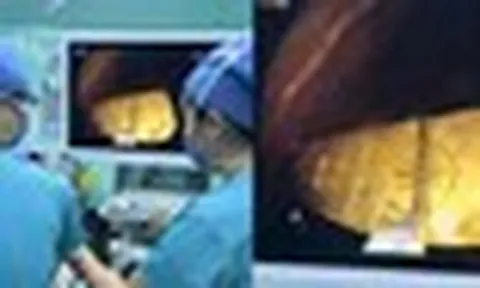 Bé gái 5 tuổi nuốt thỏi vàng 50gr, các bác sĩ nội soi gắp thành công