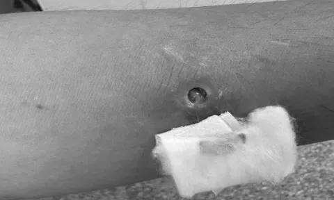 Ghi nhận ca mắc giun rồng thứ 44 tại Việt Nam