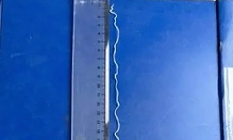Tự nặn mụn trên cánh tay, phát hiện con giun rồng dài 20cm dưới da