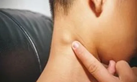 Sáng ngủ dậy thấy hạch bạch huyết bất ngờ sưng to, vì sao?