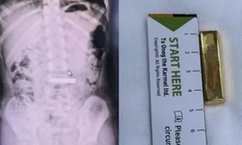 Bé gái 5 tuổi nuốt thỏi vàng dài 4cm vào bụng