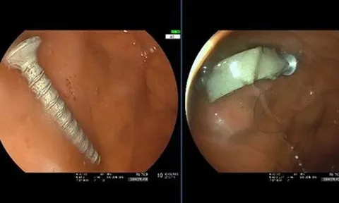 Cứu bé gái 11 tháng tuổi nuốt phải đinh vít dài 4cm