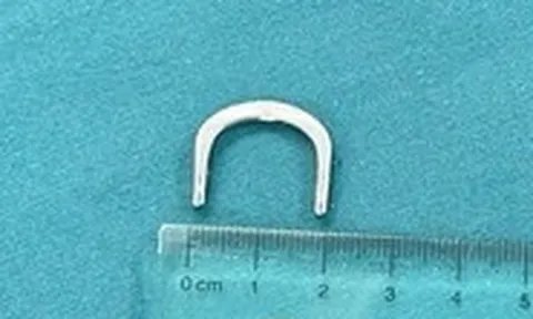 Bé gái 3 tuổi nuốt phải móc khóa dây đồng hồ, đừng tự ý 'móc họng' khi trẻ mắc dị vật