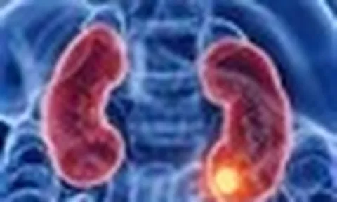 Thận đã bị tổn thương dù chưa có triệu chứng: "Thủ phạm" là 6 thói quen nhiều người vẫn làm mỗi ngày