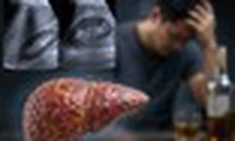 Viêm gan cấp, men gan tăng 18 lần sau 3 ngày liên tiếp dùng 1 loại đồ uống