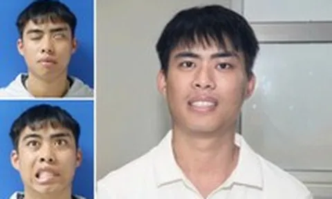 Phục hồi thành công gương mặt cho nam thanh niên liệt mặt suốt 7 năm