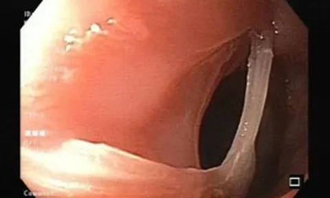 Cụ ông 81 tuổi suýt gặp nguy vì xương ghẹ mắc kẹt trong thực quản