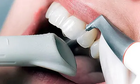 Vệ sinh răng sứ đúng cách để sau phục hình răng đảm bảo bền đẹp lâu dài