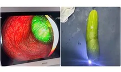 Nam sinh lớp 9 nhập viện vì 'nghịch dại', đưa quả dưa chuột dài 20cm vào hậu môn