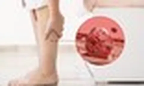 Bất kể giới tính, nếu điều này xuất hiện trên chân, đó có thể là dấu hiệu của cục máu đông trong cơ thể
