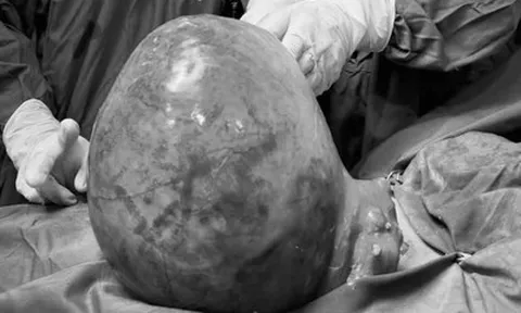 Tưởng béo bụng, người phụ nữ 51 tuổi bất ngờ phát hiện khối u nặng 6kg