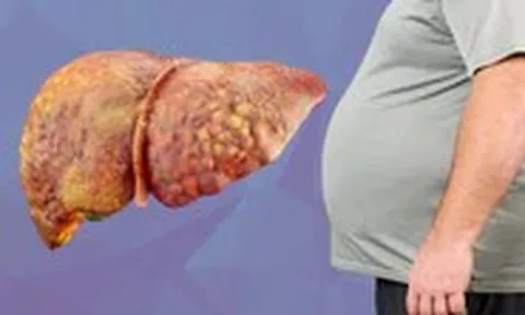 Loại thực phẩm đưa bạn đến gần hơn với bệnh gan nhiễm mỡ