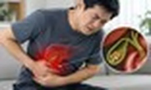 Bác sĩ chỉ 4 dấu hiệu cảnh báo sỏi mật, một dấu hiệu dễ nhận thấy sau bữa ăn