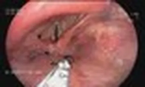 Đàn kiến chui vào thanh quản người đàn ông