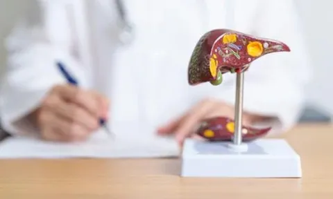Thuốc bổ gan, giải độc gan có chữa được gan nhiễm mỡ?