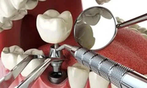 Người bệnh đái tháo đường có nên cấy implant ngay sau khi nhổ răng?