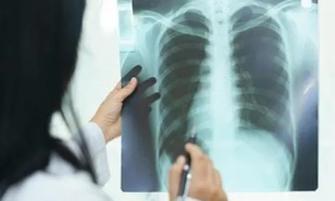 "Thủ phạm" gây xơ phổi không hồi phục, đôi khi tử vong nhanh hơn cả ung thư
