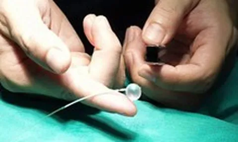 Lần đầu tiên tại Việt Nam: Đặt bóng vào khí quản thai nhi 30 tuần tuổi, cứu trẻ từ trong bụng mẹ