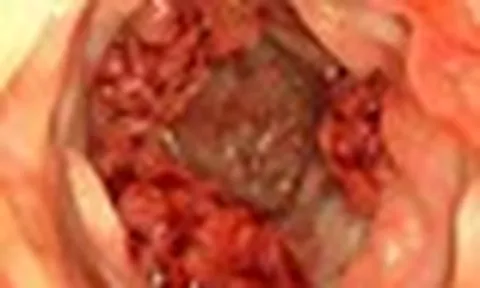 Bác sĩ cảnh báo 5 dấu hiệu ung thư đại trực tràng thường bị bỏ sót