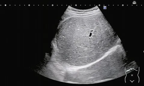 Người đàn ông 35 tuổi "gan trắng xóa" vì ngày nào cũng uống thứ nước "vạn người mê"