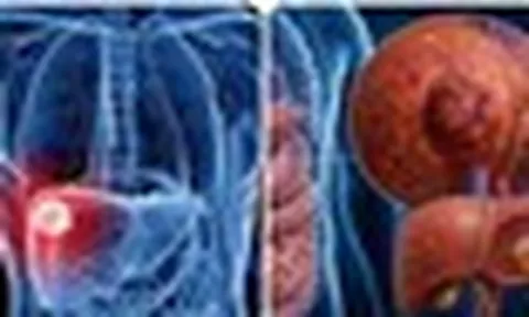 9 triệu chứng ung thư gan giai đoạn đầu