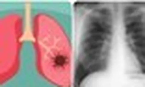 9 dấu hiệu ung thư phổi giai đoạn đầu