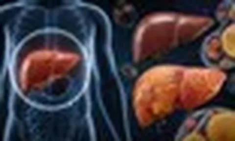1 loại thực phẩm có thể hại gan hơn cả rượu bia nếu tiêu thụ quá nhiều: Thích đến mấy cũng phải hạn chế