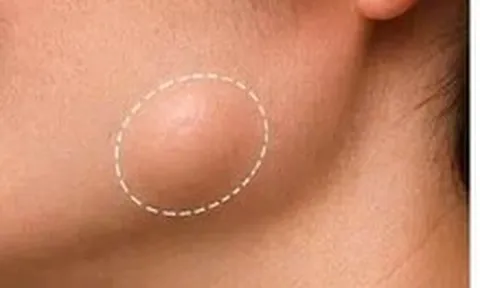 Thấy khối u mỡ ở vùng đầu, cổ: Khi nào đáng lo?