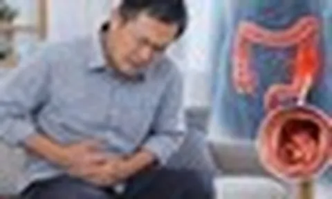 Bác sĩ chỉ: 6 DẤU HIỆU cảnh báo ung thư ruột, nhiều người nhầm tưởng là "rối loạn tiêu hóa"
