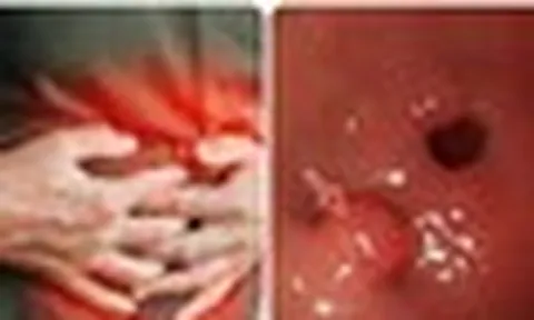 7 dấu hiệu ung thư dạ dày không nên bỏ qua