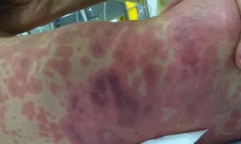 Bệnh não mô cầu, đừng chờ nổi ban mới đi viện