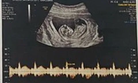 Mất cân bằng giới tính khi sinh: Cần siết việc xử phạt hành vi lựa chọn giới tính