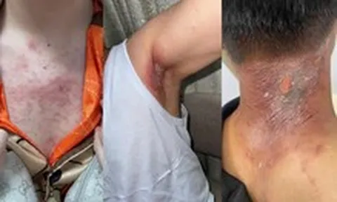Kiến ba khoang 'vào mùa', cẩn trọng nhầm tổn thương da với zona thần kinh