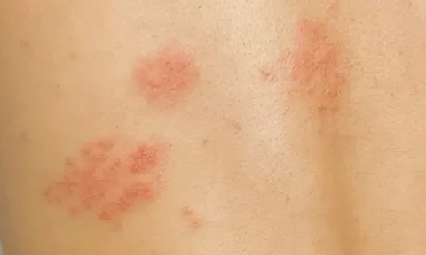 Da đã lành, cơn đau sau zona thần kinh vẫn gây mất ngủ, trầm cảm