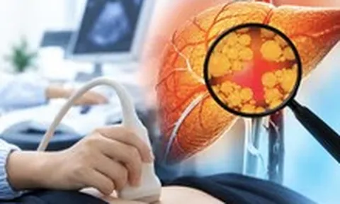 Tập thể thao, ít rượu bia vẫn bị gan nhiễm mỡ vì thói quen tưởng chừng lành mạnh
