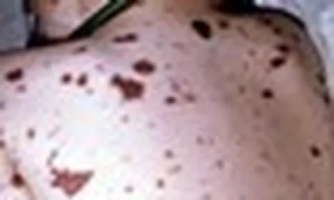 TP.HCM ghi nhận thêm 1 ca mắc viêm não mô cầu