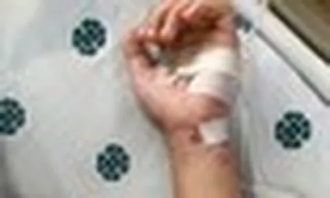 Thêm một ca não mô cầu tại TP.HCM, trẻ đã tiêm vaccine vẫn mắc bệnh: Bác sĩ cảnh báo 4 nhóm người có nguy cơ cao