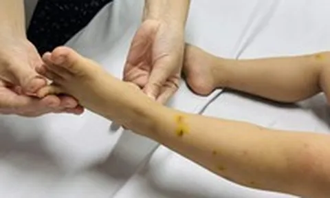 TP.HCM ghi nhận hơn 44.000 ca tay chân miệng, nhiều ca dương tính vi rút EV71 gây bệnh nặng