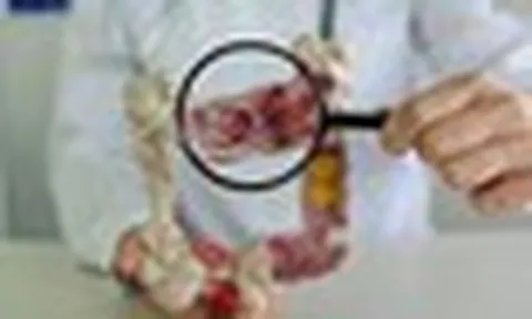 Ung thư đại tràng thường "để ý" những người có 2 đặc điểm này: Nếu có cần hành động ngay!